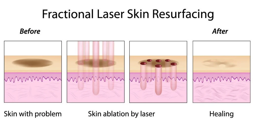 3D CO2 Fractional Laser Promote Collagen Re-Growth Beauty Equipment