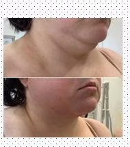 3D Portable Hifu Face Lifting Slimming Machine Beijing Noble Laser